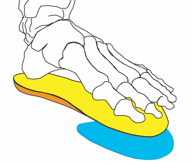 Illustration of a human foot skeleton on a yellow In-Shoe Wedge, featuring a blue section under the front part of the wedge.